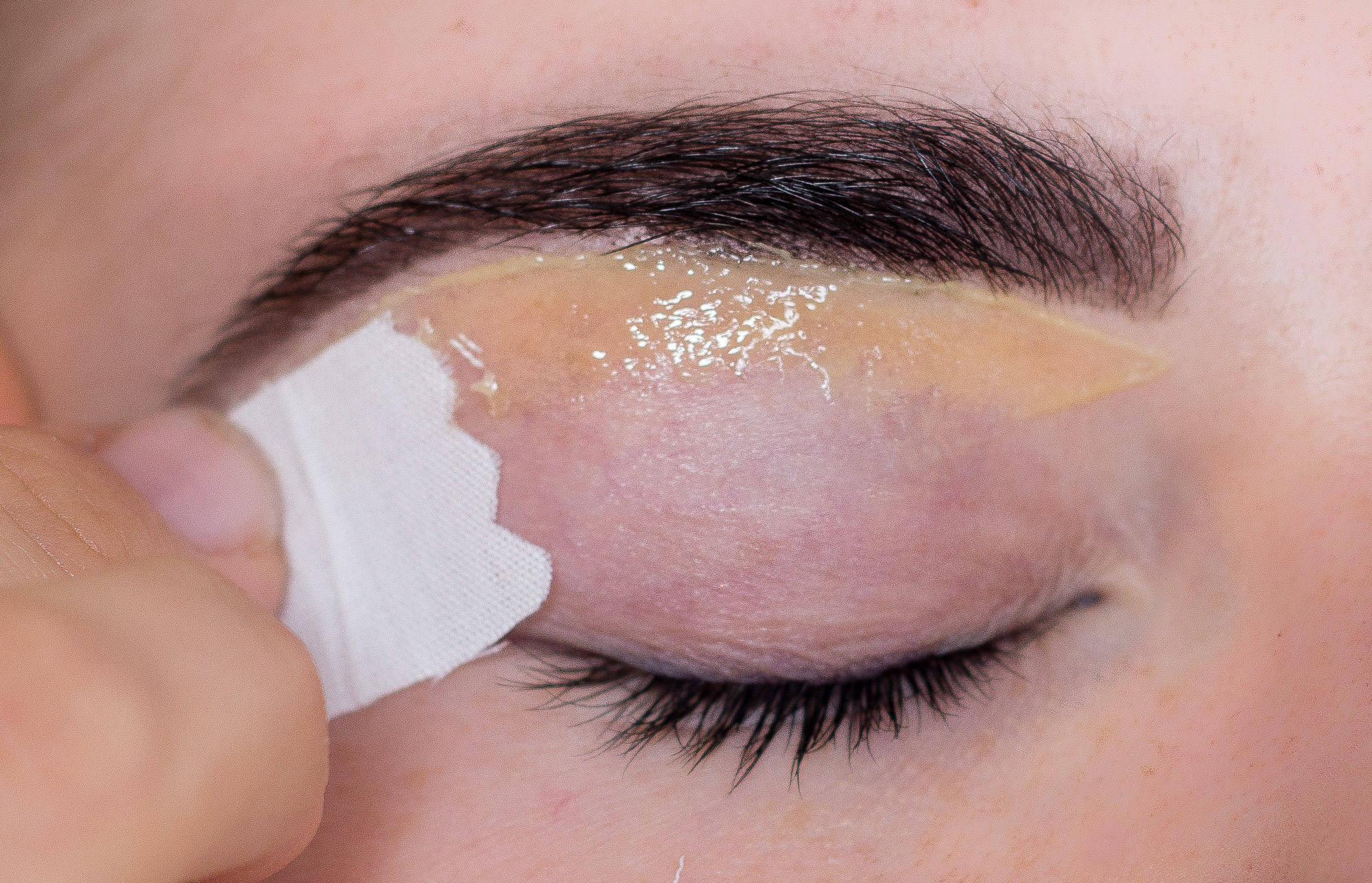 Microneedling