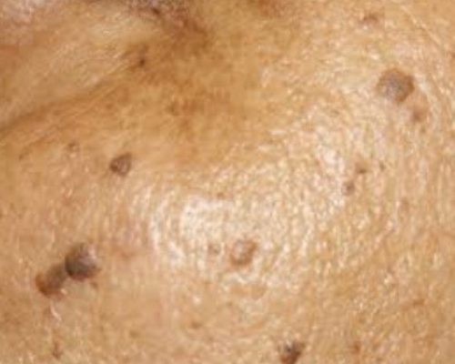 Dermatosis Papulosa Nigra (DPN)