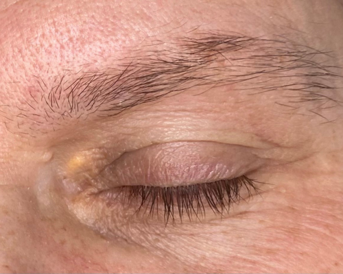 Xanthelasma Palpebrarum