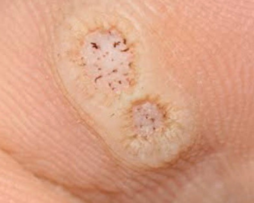 Warts