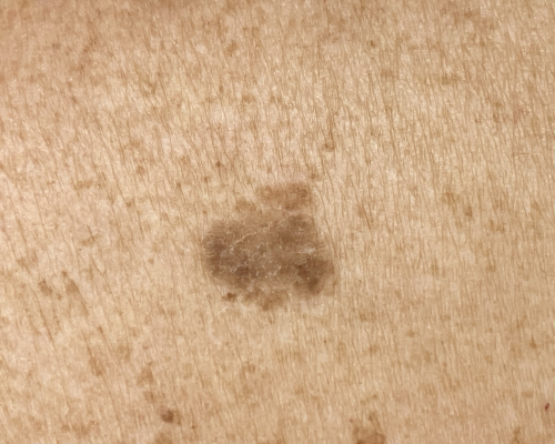 Seborrheic keratosis