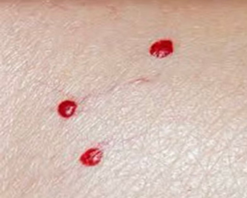 Blood Spots
