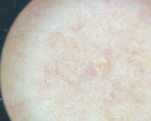 Sebaceous Hyperplasia