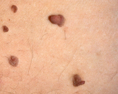 Skin tags