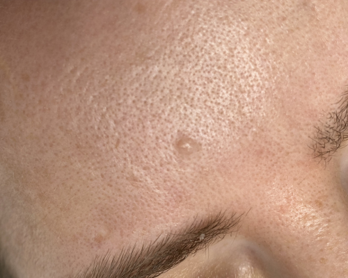 Sebaceous Hyperplasia