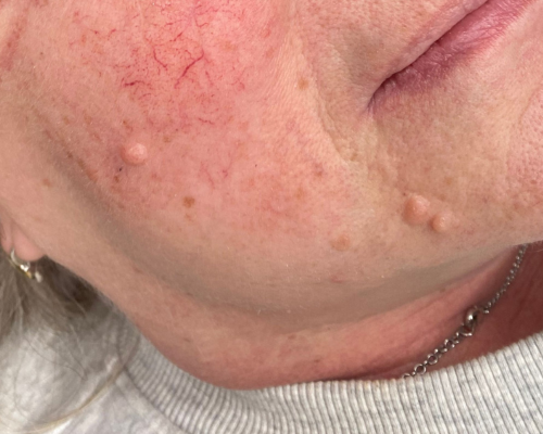 Mole Removal