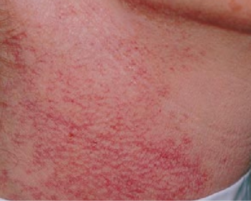Warts