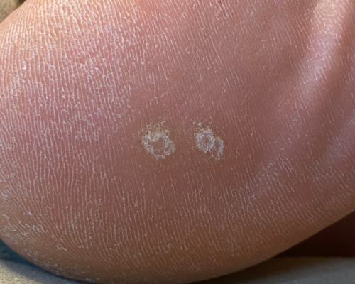 Ages Spots