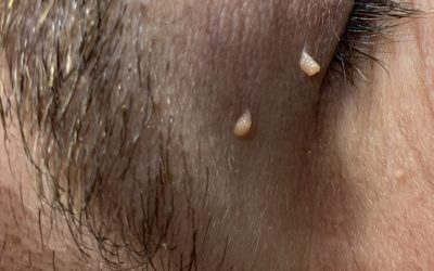 How to remove Skin Tags and other Common Blemishes